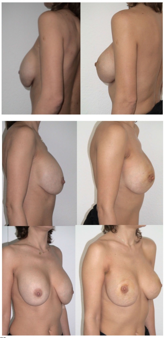 Подтяжка груди нитями: фото до и после