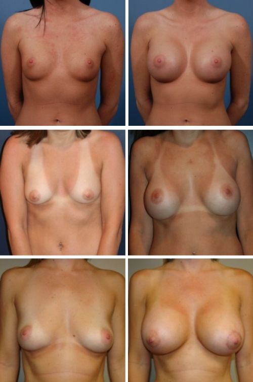 увеличение грудных желез фото до и после