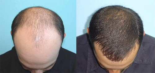 пересадка волос фото до и после