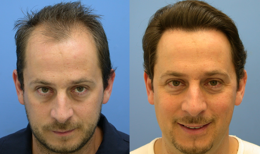 Трансплантация волос фото до и после