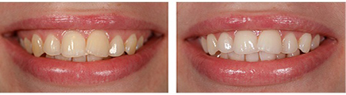 ультразвуковое отбеливание зубов фото до и после