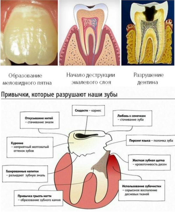 Причины разрушения зубной эмали